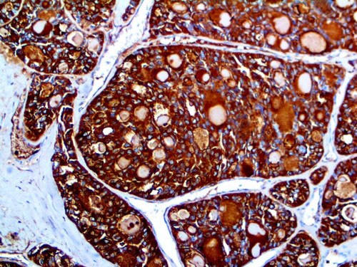 IHC of Thyroglobulin on an FFPE Papillary Thyroid Carcinoma Tissue